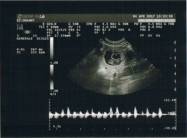 ecografia gravidanza